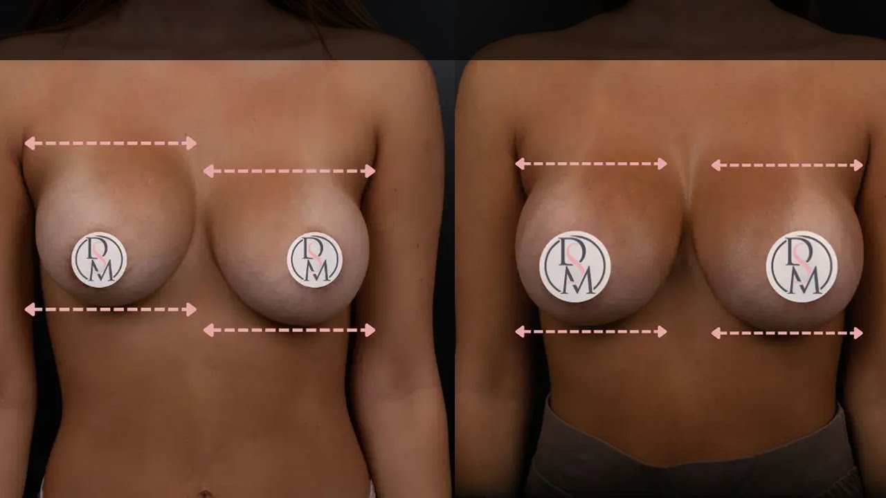 Experiencing Capsular Contracture? | Donald Mowlds, MD
