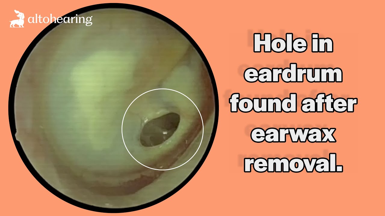 What Caused This? | Ear Wax Removal with Alto Hearing