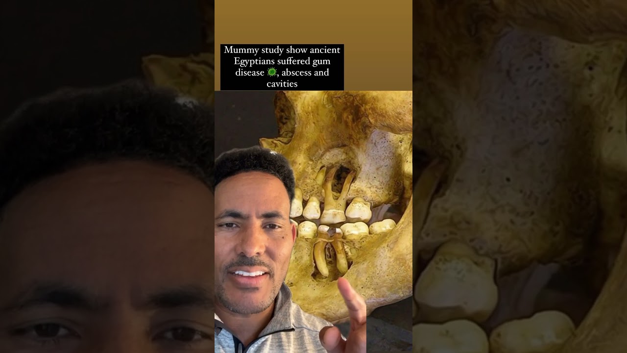 Tooth infection if not treated , causes lots of damage to the bone