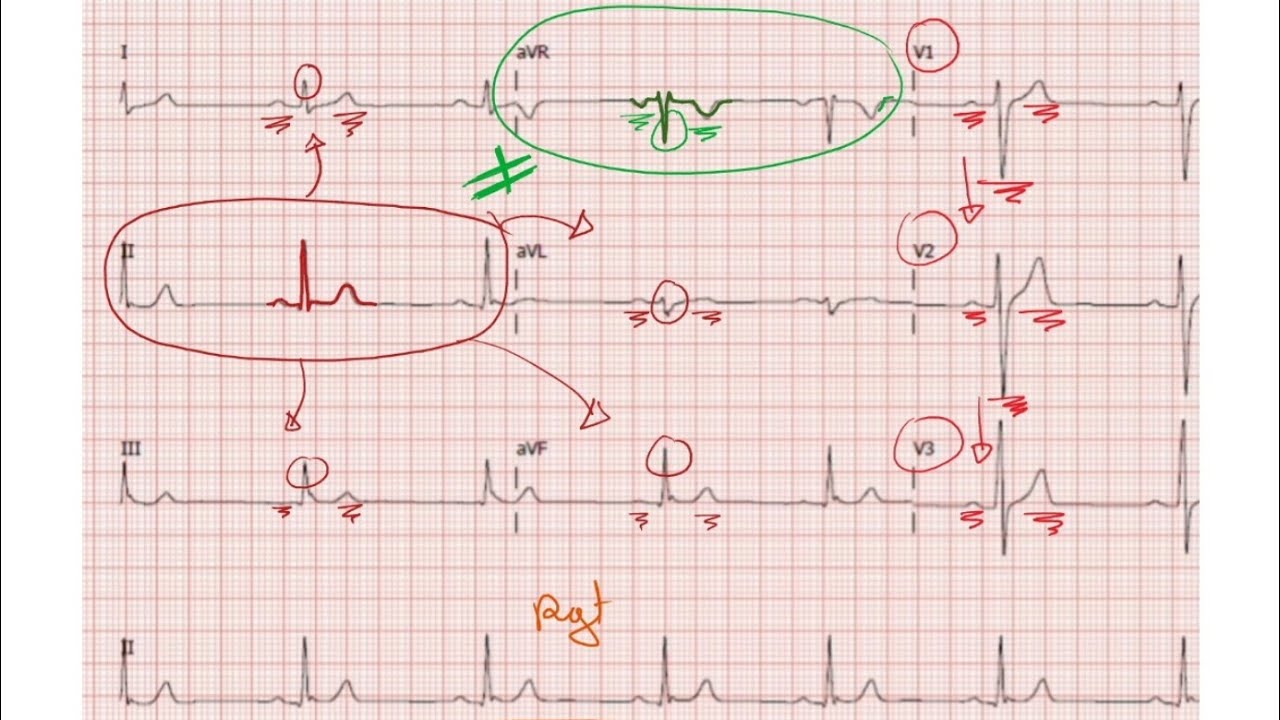 ECG de A à Z : Les ondes PQRST prt 2