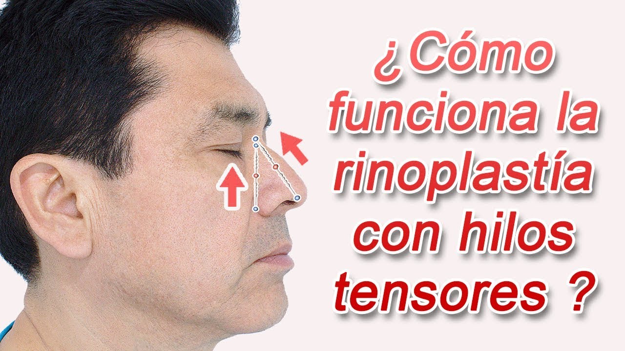 ¿Cómo funciona la Rinoplastía con Hilos Tensores?