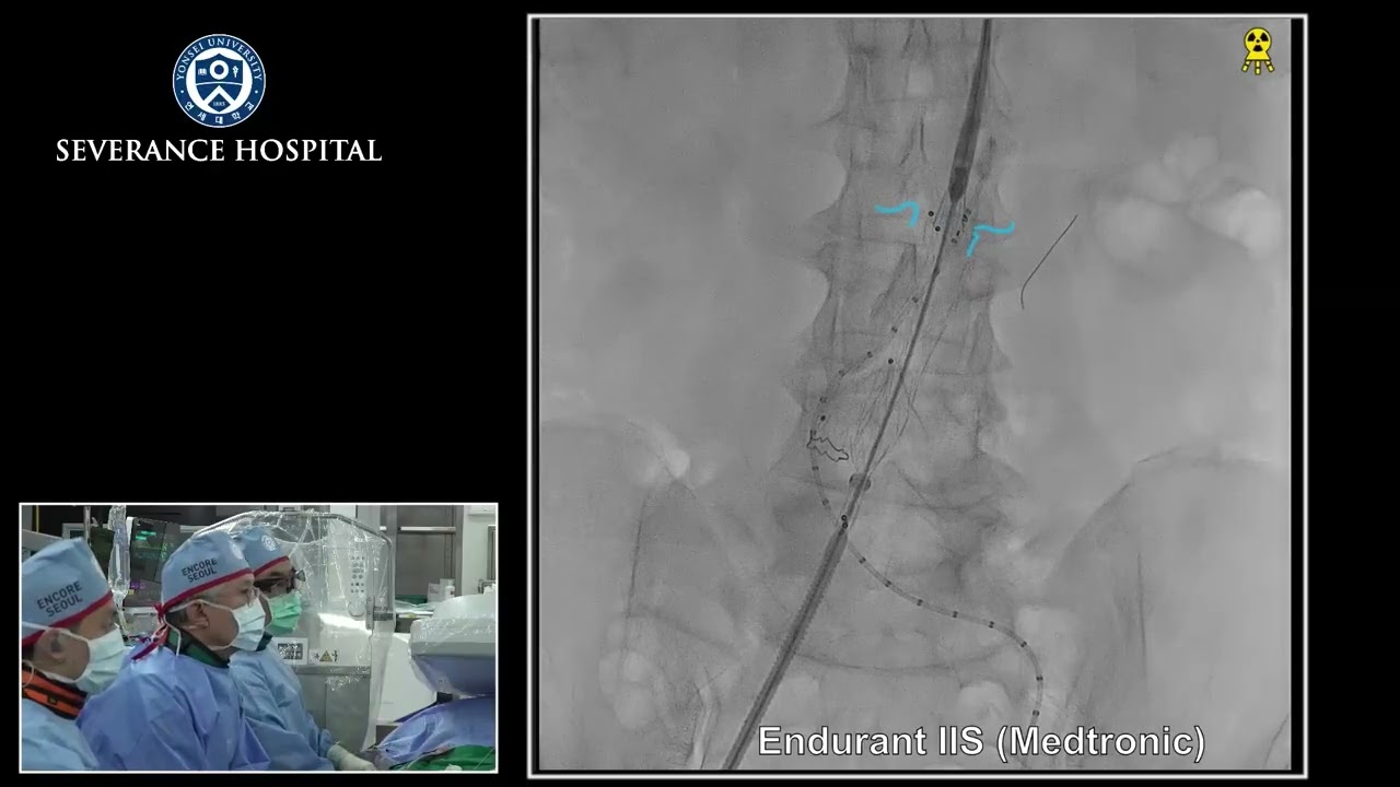 ENCORE SEOUL 2025 Live Demonstration (EVAR)-Donghoon Choi, MD/PhD (Severance Hospital)