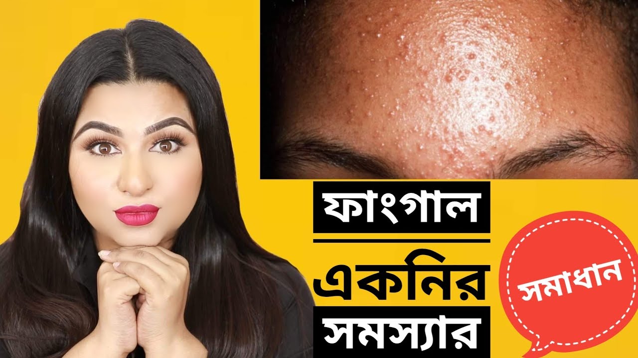 ফাংগাল একনি কি? 2019 | ফাংগাল একনি দূর করার উপায় - Fungal Acne Safe Products || Ananya Artistry