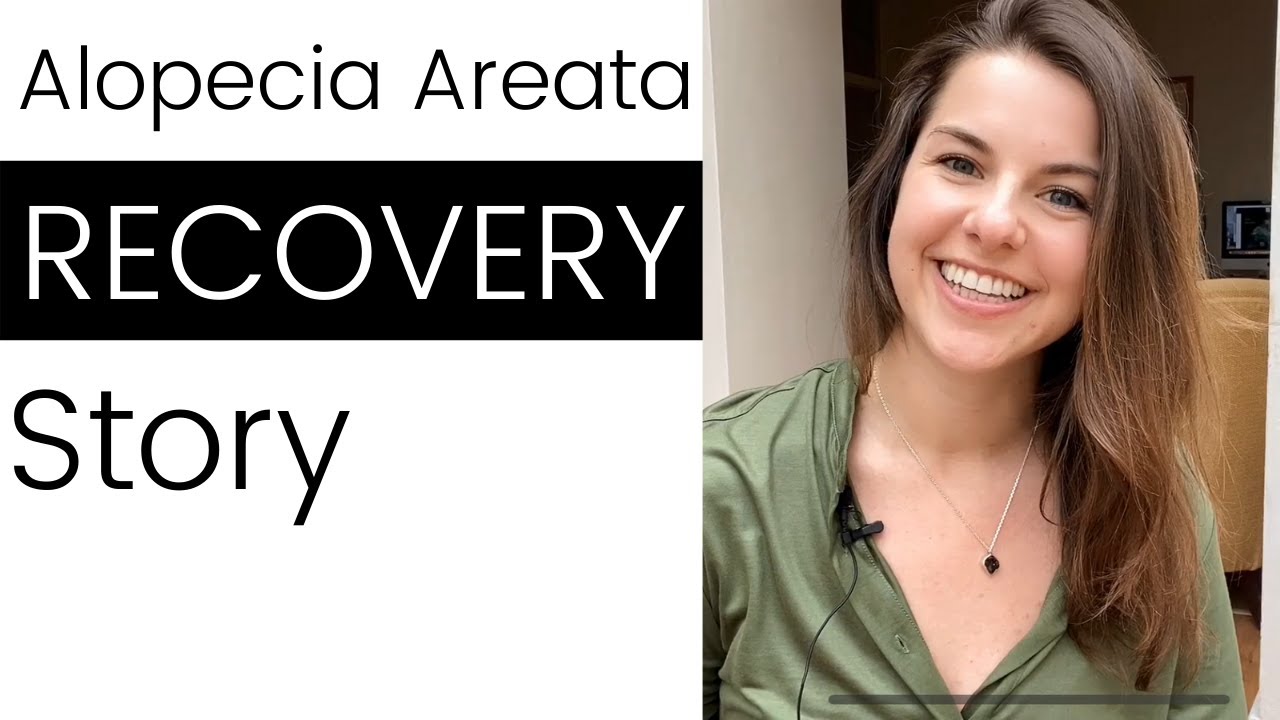 Alopecia Recovery | One Year Later | My Alopecia Story