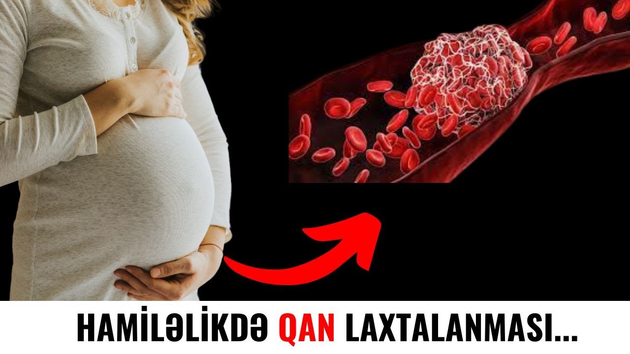 Hamilə Qadınlar DİQQƏT!- Qanınızda Laxtalanma Varsa...