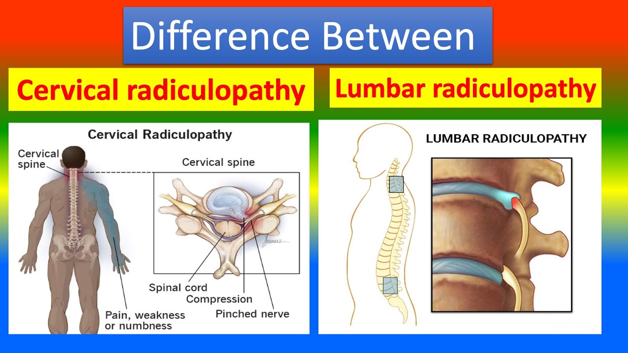 Difference between Cervical Radiculopathy  and  Lumbar Radiculopathy