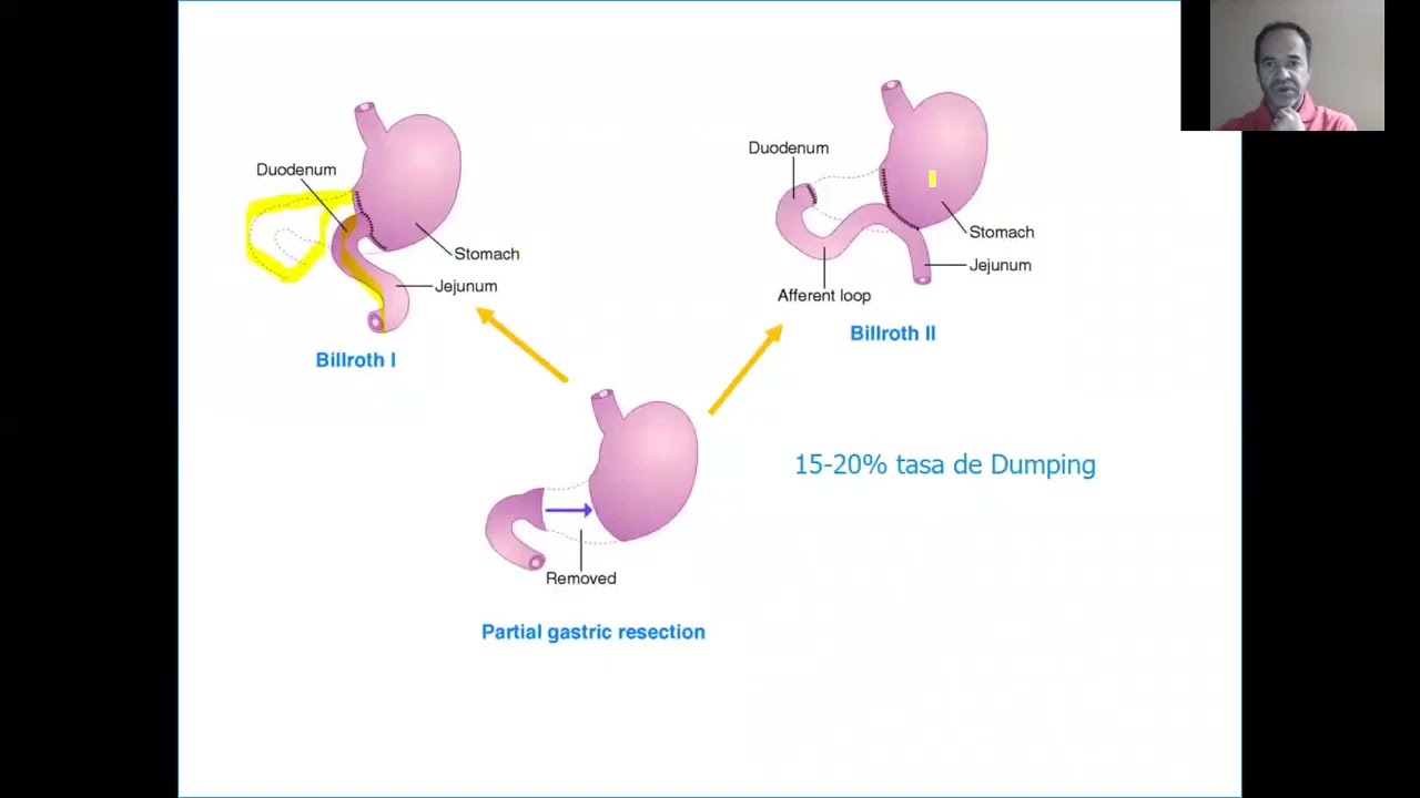 Clase Fisiopatologia y Dietoterapia del Adulto, Sindrome de Dumping