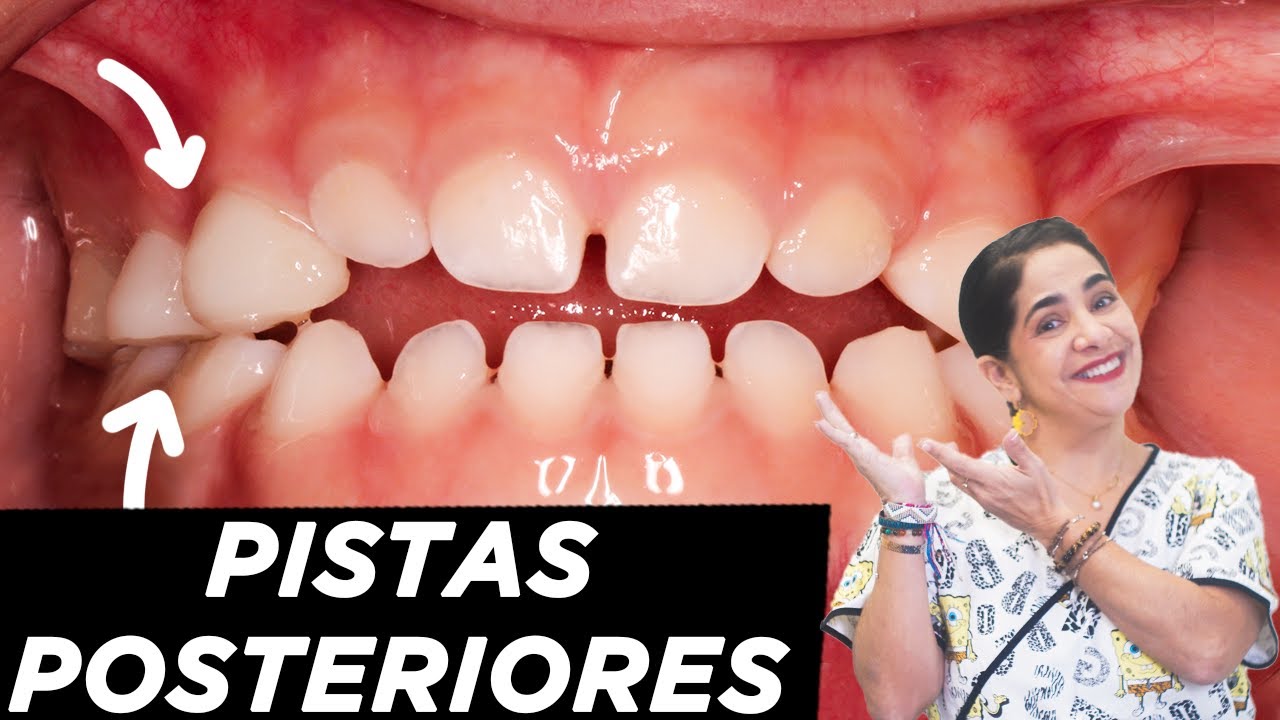 Pistas para descruzar mordidas!