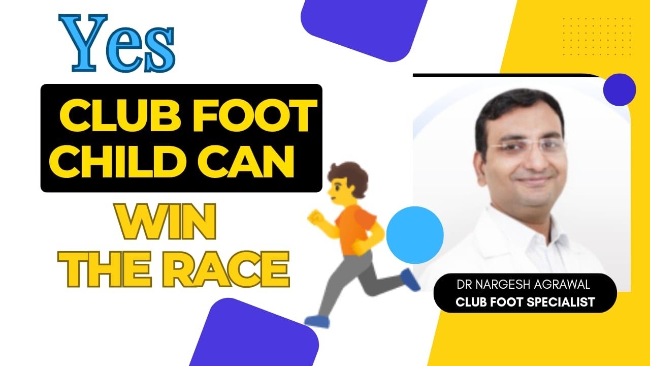 Clubfoot treatment in Delhi #ctev #clubfoot #childorthoclinic #paediatricortho @childorthocare