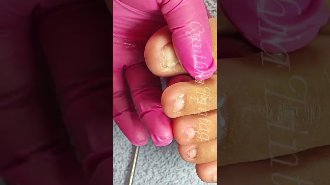 Full video pedicure and Dryskin removal 