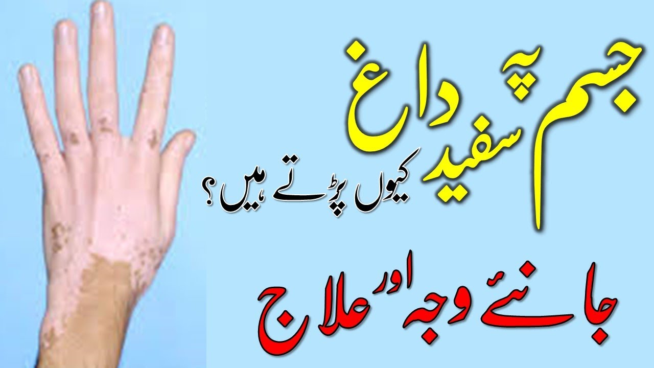 Bars (Leucoderma) Ki Waja & Ilaj | Tibe Ahlebait (Part 25) | پھلبہری | Maulana Syed Ali Naqi Kazmi