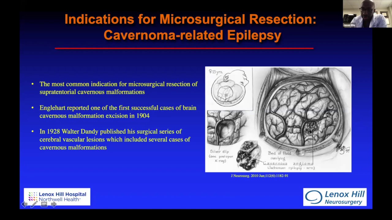 Virtual Cerebrovascular OR: Cerebrovascular Malformations with Dr. Ellis