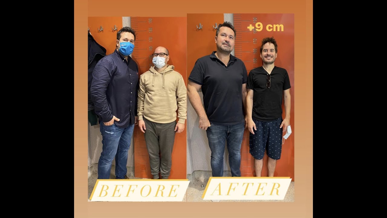 + 9 cm My Limb lengthening surgery changed my Life. Meine Beinverlängerung hat mein Leben geändert.