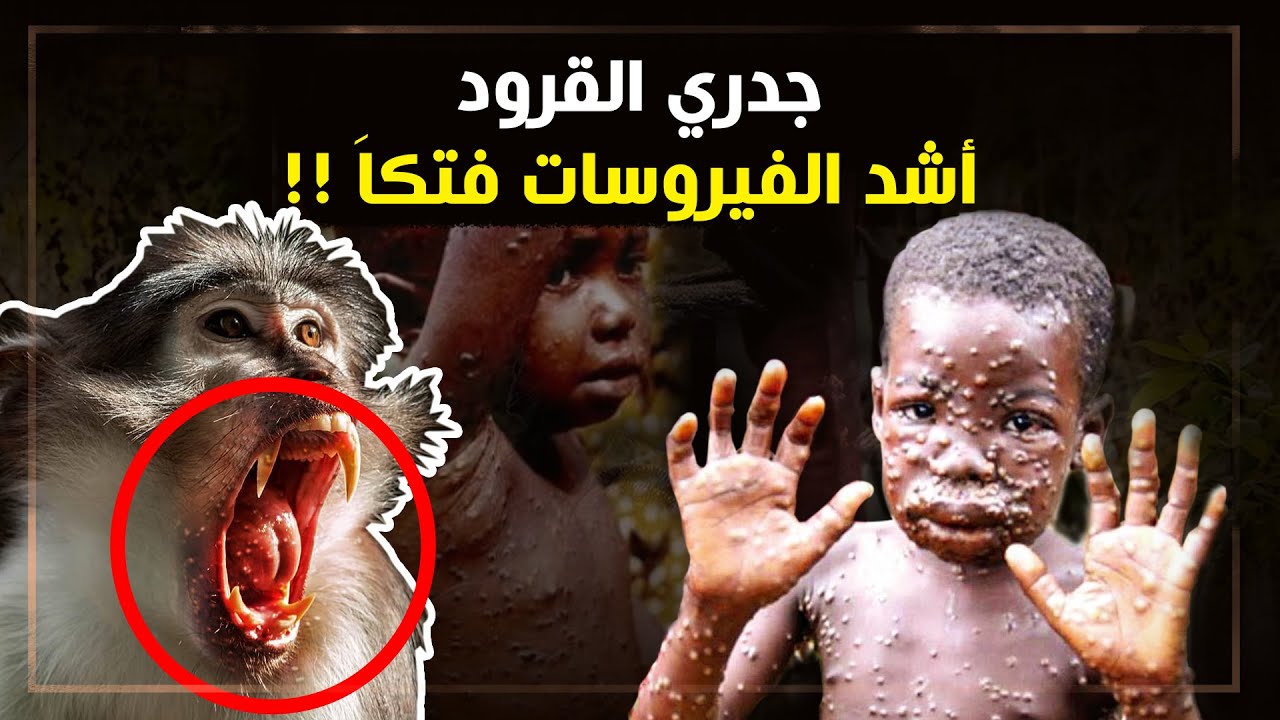 جدري القرود .. فيروس نادر .. كيف يصيب البشر وماذا نعرف عنه وهل له لقاح ام لا ؟؟