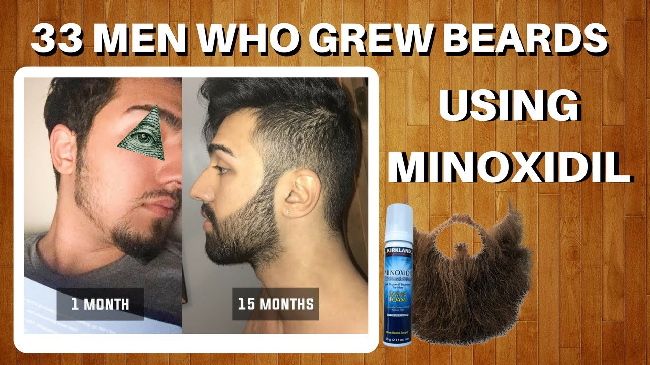 33 Men Who Grew Beards Using Minoxidil | The Minox Beard Spot | Minoxidil Beard Showcase