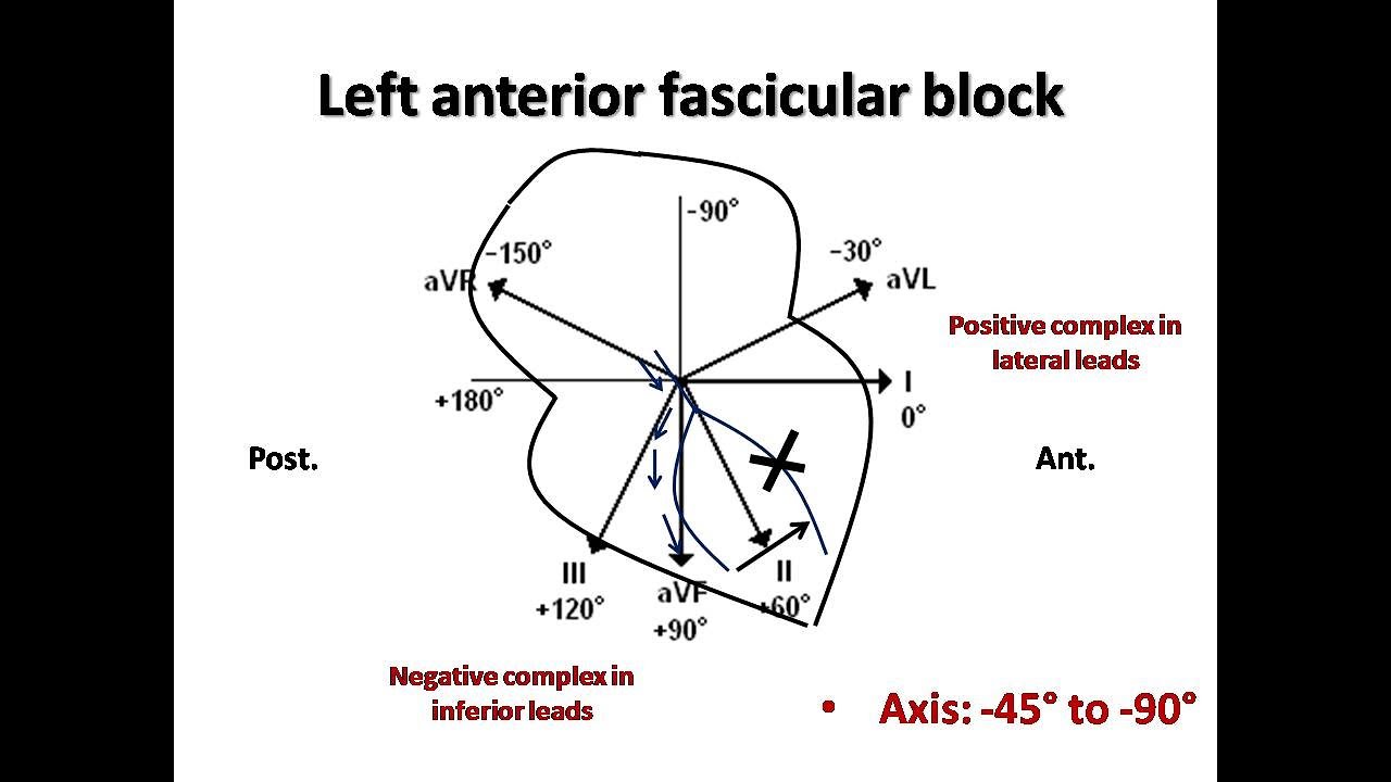 ECG course: Fascicular Blocks, Dr. Sherif Altoukhy