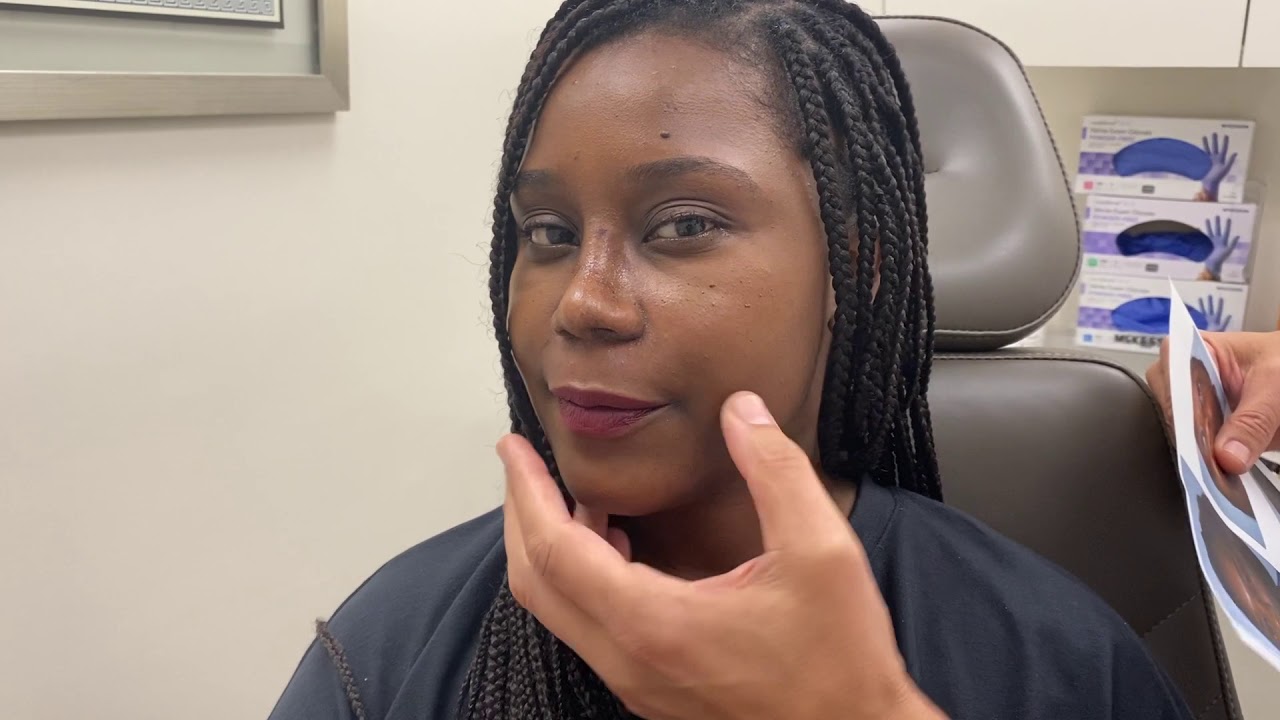 African American Rhinoplasty - After One Week
