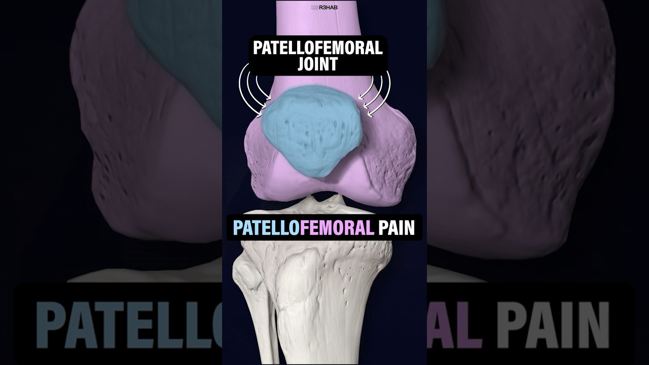 What Is Patellofemoral Pain (Runner&rsquo;s Knee)? #shorts