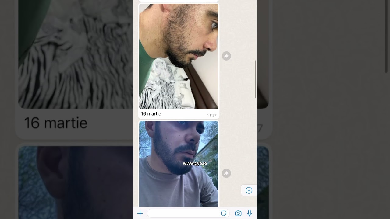 Tratament pentru cresterea barbii cu Minoxidil🔥🧔🏽&zwj;♂️ #dermaroller #beard #beardgrowth #foryou