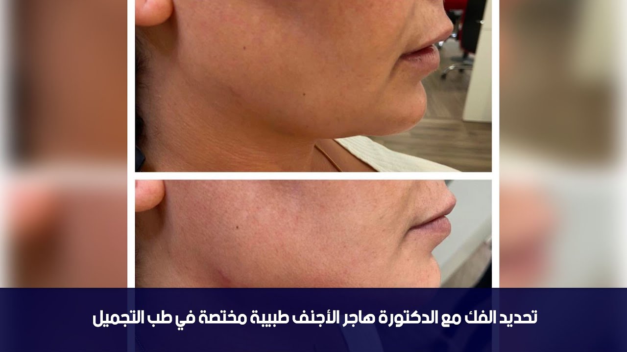 تحديد الفك مع الدكتورة هاجر الأجنف طبيبة مختصة في طب التجميل