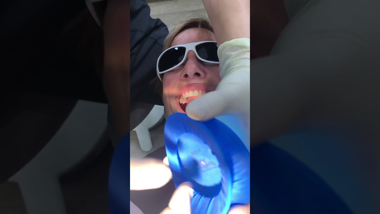 Optradam Plus_Placement in the mouth
