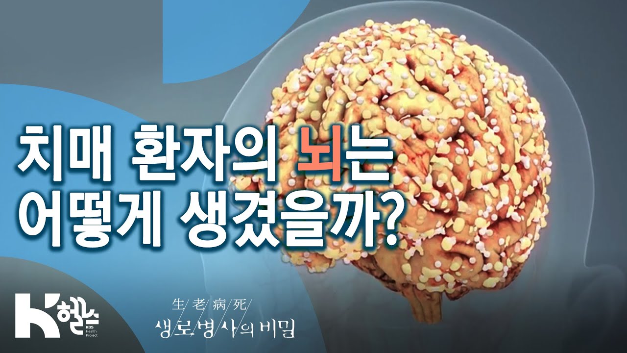 치매 환자의 뇌는 어떻게 생겼을까? - (20.03.25 생로병사의 비밀 스페셜 방송) 치매와의 전쟁-치매쇼크 치매혁명