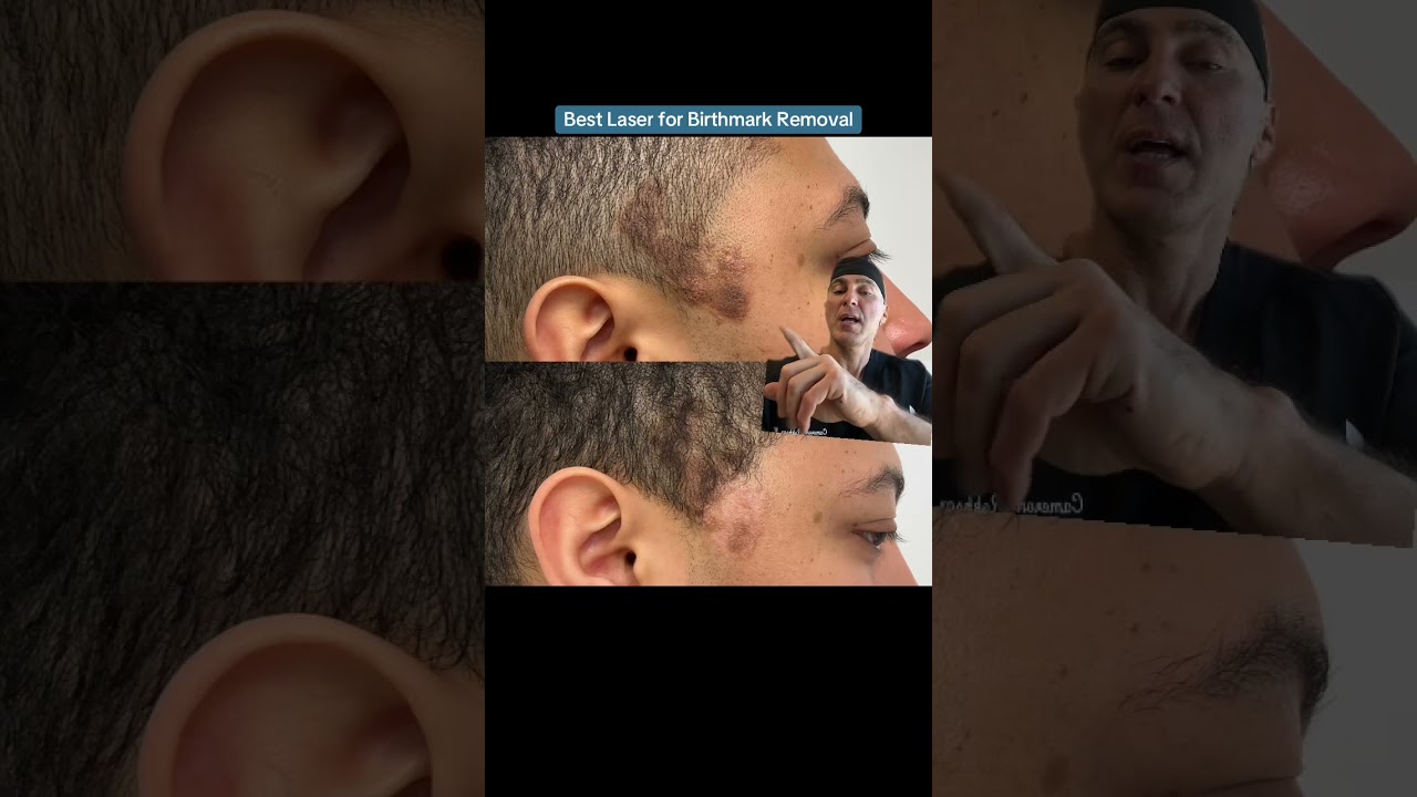 Best Laser for Birthmark Removal