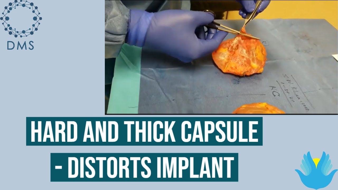 CAPSULAR CONTRACTURE! - Hard and Thick Capsule - Distorts Implant - Breast Implant Illness - BII