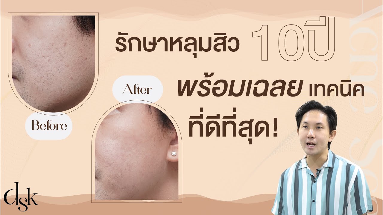 รักษาหลุมสิวต้องดู! รีวิวรักษาหลุมสิว 10 ปี ผ่านมาแล้วทุกเลเซอร์ ทุกเทคนิค ไม่ดีขึ้นเลย !