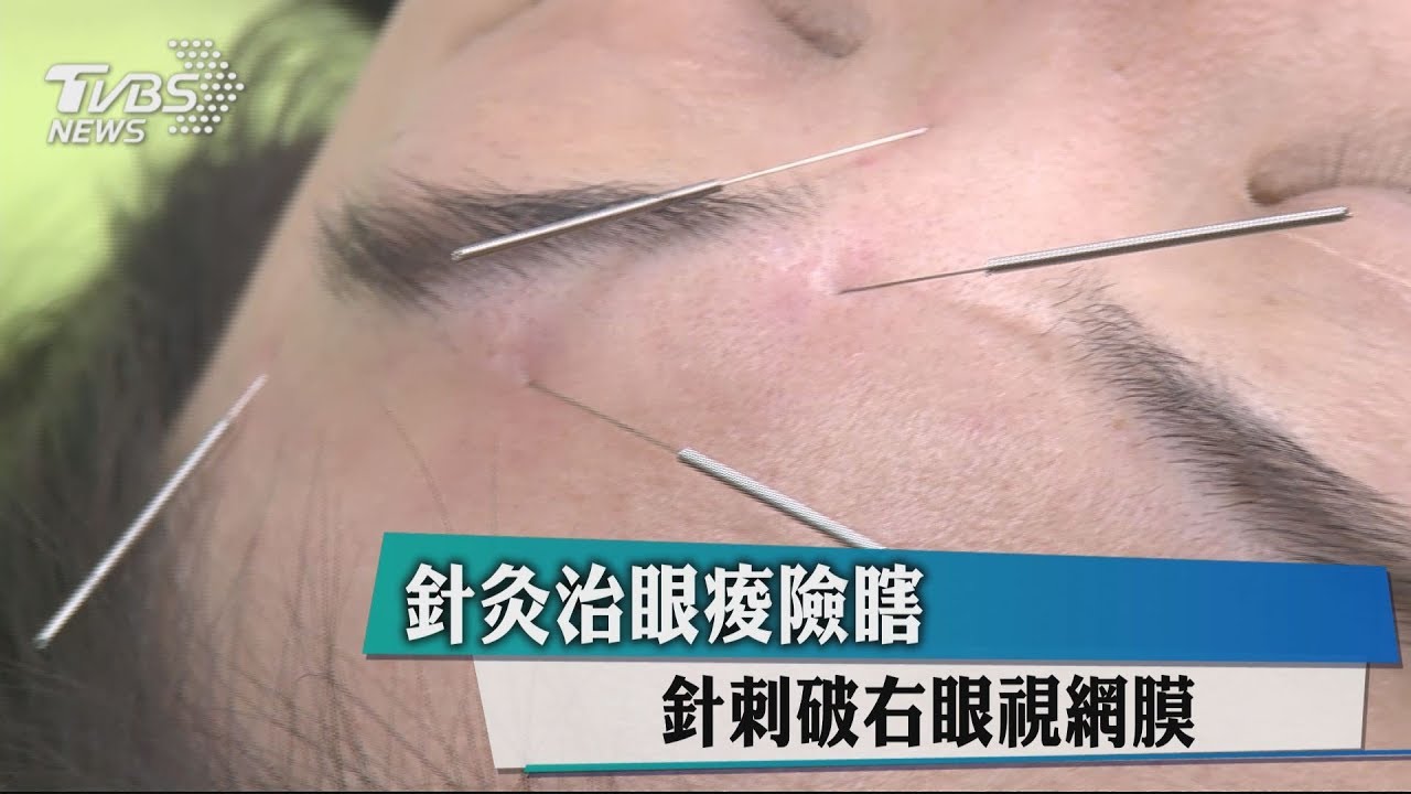 針灸治眼痠險瞎　針刺破右眼視網膜