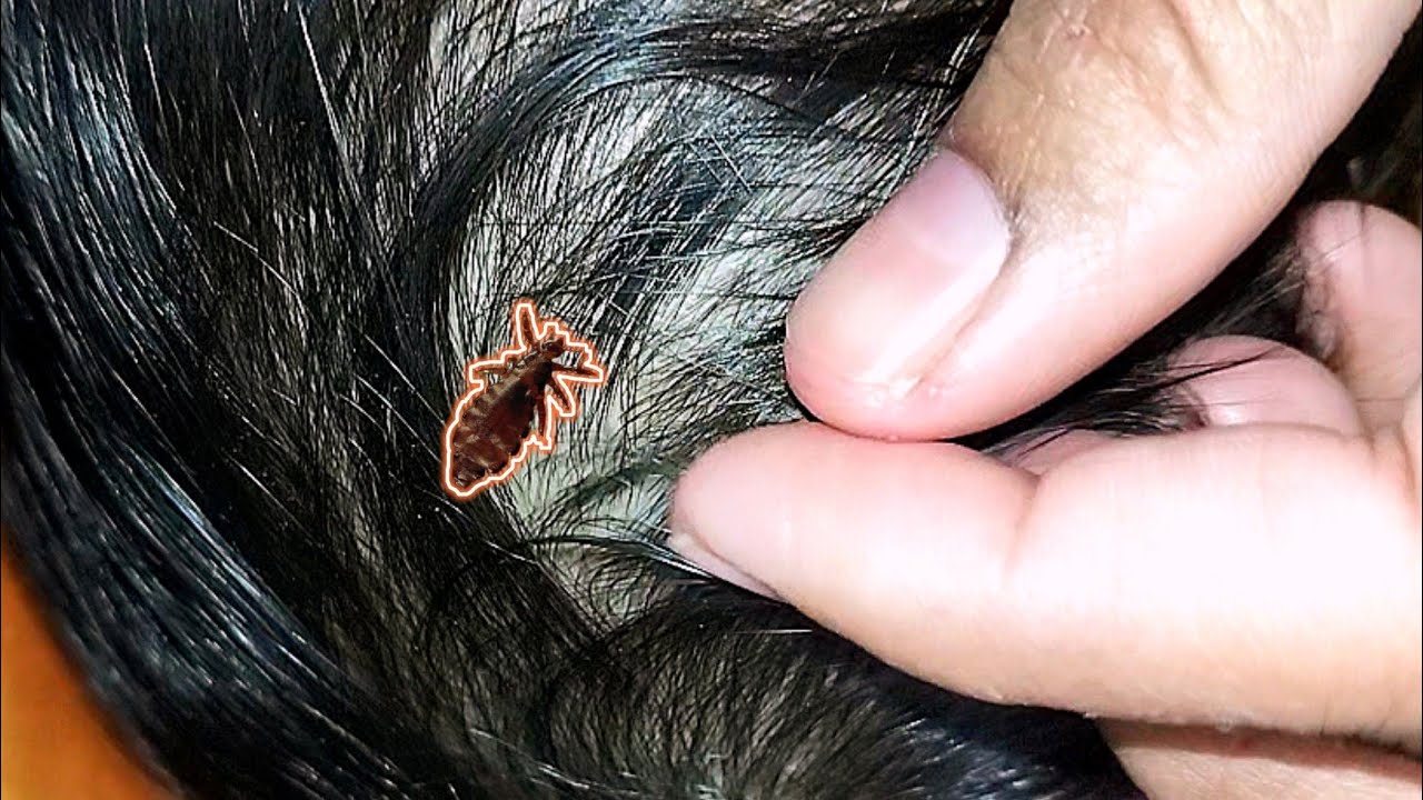 How I Found a Liceeeee 😮living in My Baby's Hairs ✨ Part12 😲 