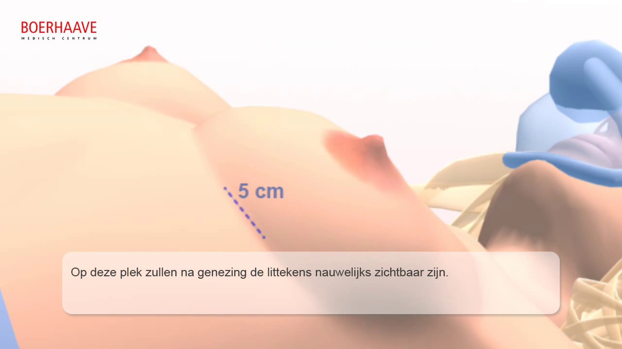 Borstvergroting Animatie - Boerhaave Medisch Centrum