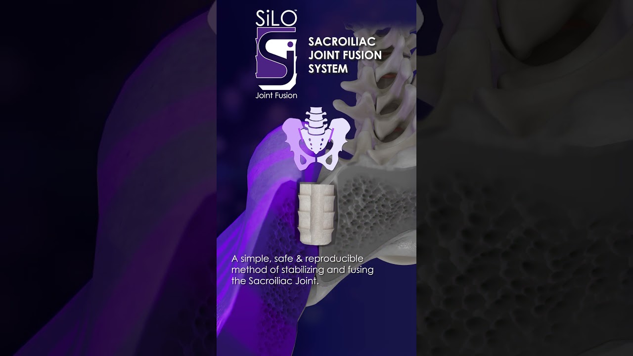 SiLO&trade; a single implant posterior SI fusion #patientsfirst #PurposeDriven #medicalanimation