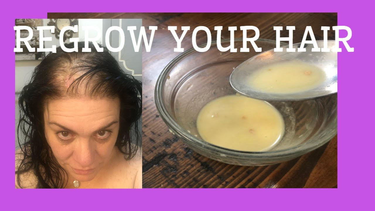 TRIPLE HAIR GROWTH with Ginger Juice Immediately REGROW BALDING HAIR EXTREME GROWTH