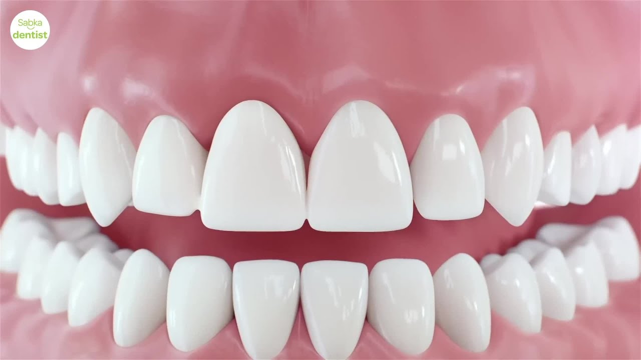 🦷 Dental Implant Procedure: How to Replace a Missing Tooth Permanently!