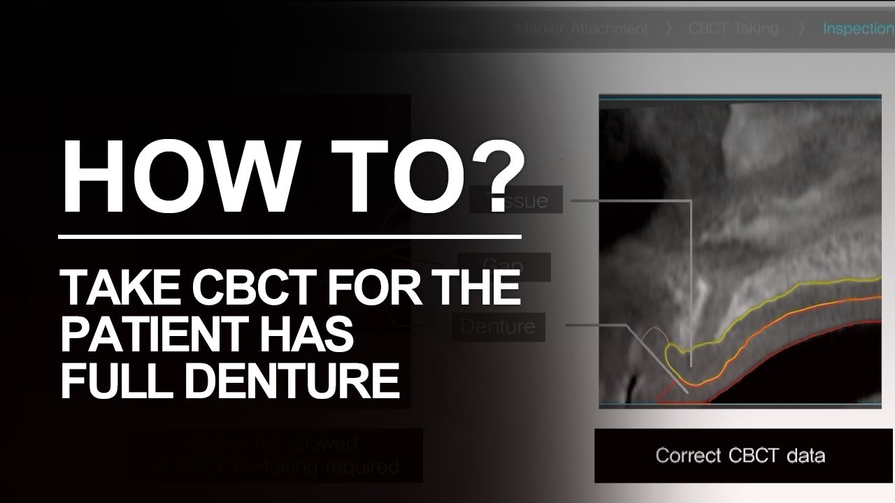 Take CBCT for a full Denture (DIOnavi. Learning Contents)