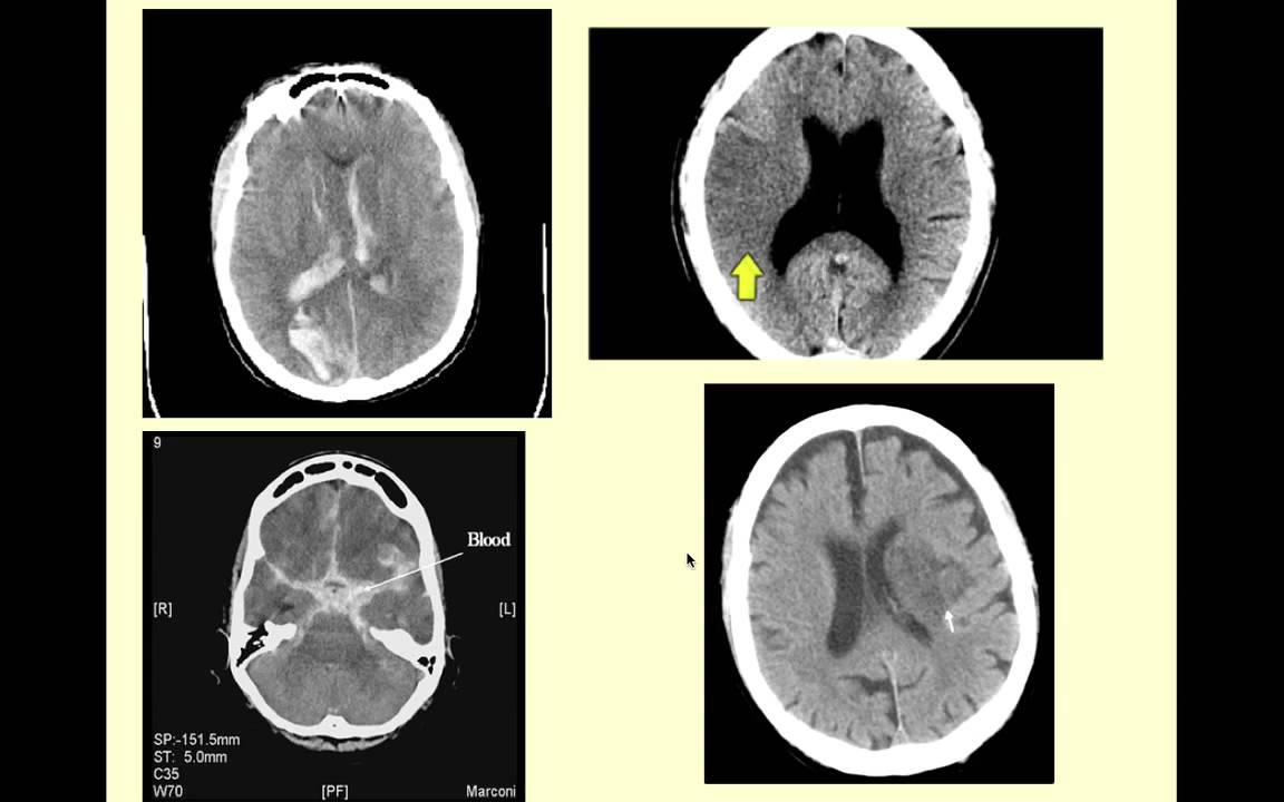 Stroke Syndromes - CRASH! Medical Review Series