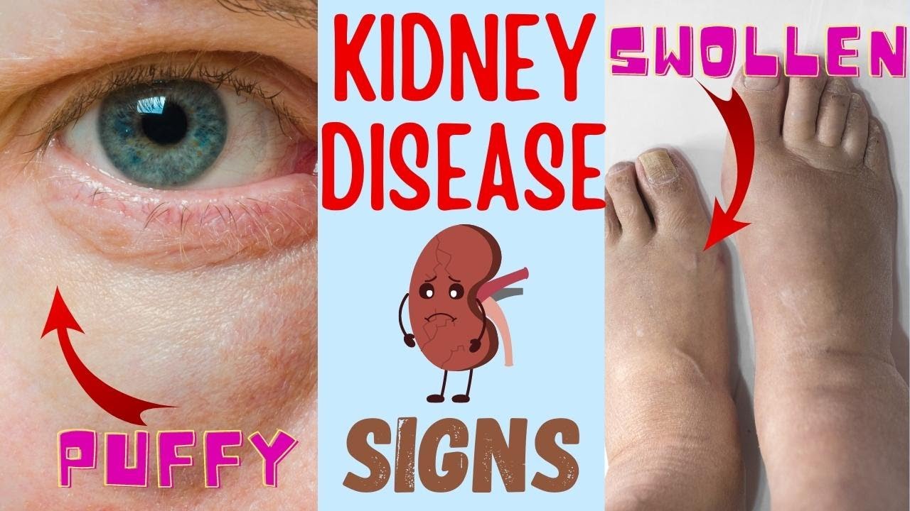 10 Warning Signs your KIDNEYS are TOXIC