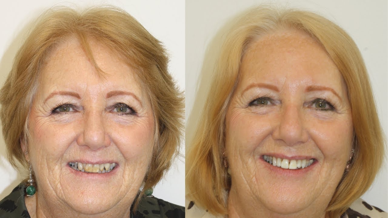 Vanessa's Invisalign Journey | Straighter teeth with Dr. Arnold