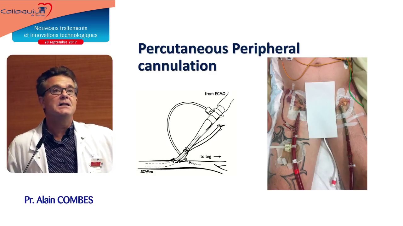 05 - L'ECMO pour le cardiologue