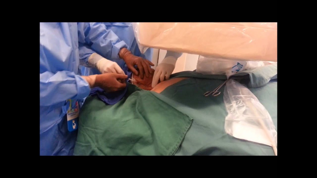 Hickman's catheter 的應用及植入術Hickman's catheter insertion and application