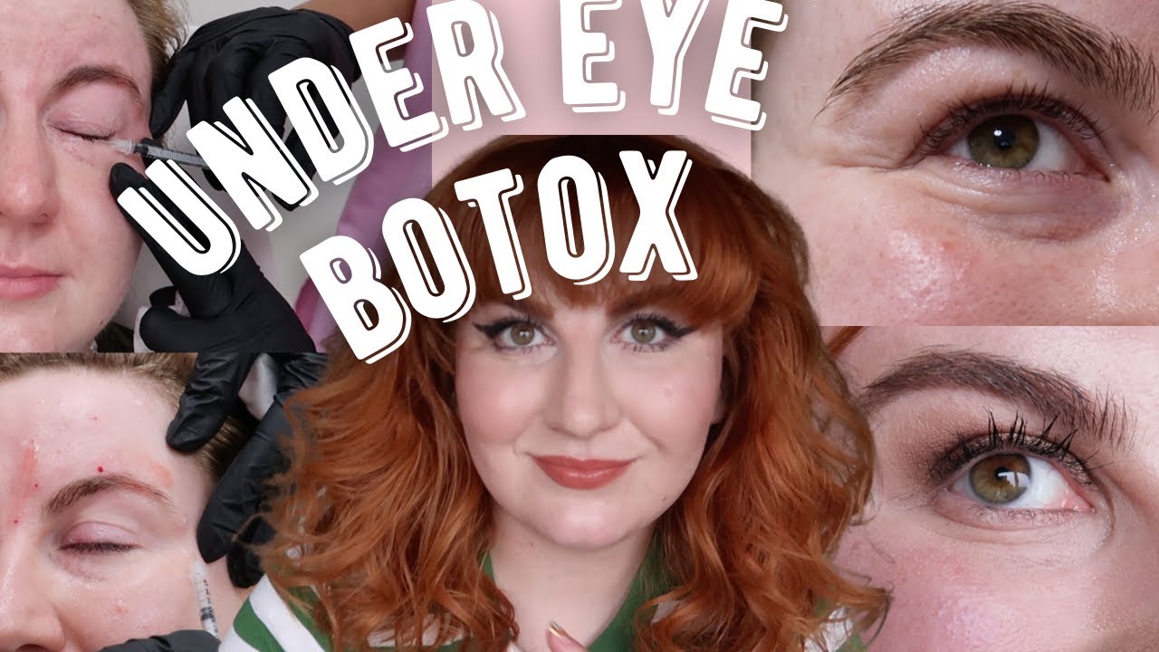 TRYING UNDER EYE BOTOX | Rose Keats