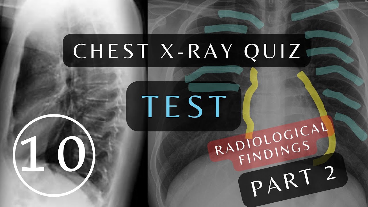 Can You Pass This Quiz: Questions and Answers Part 2 | 10 Essential Chest X-rays #xray #respiratory