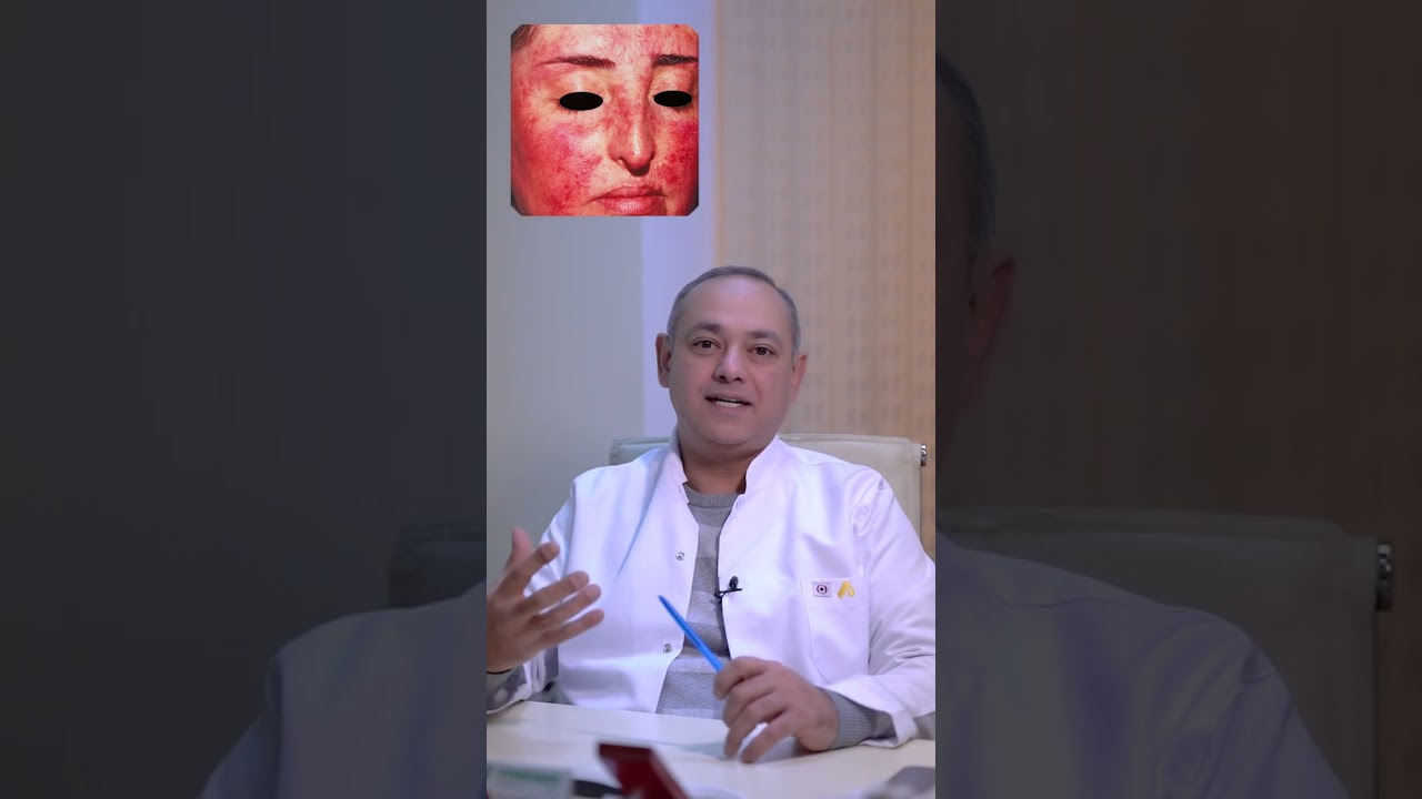 Rosacea xəstəliyi nədir ? - Dermatoloq Elşad Novruzov
