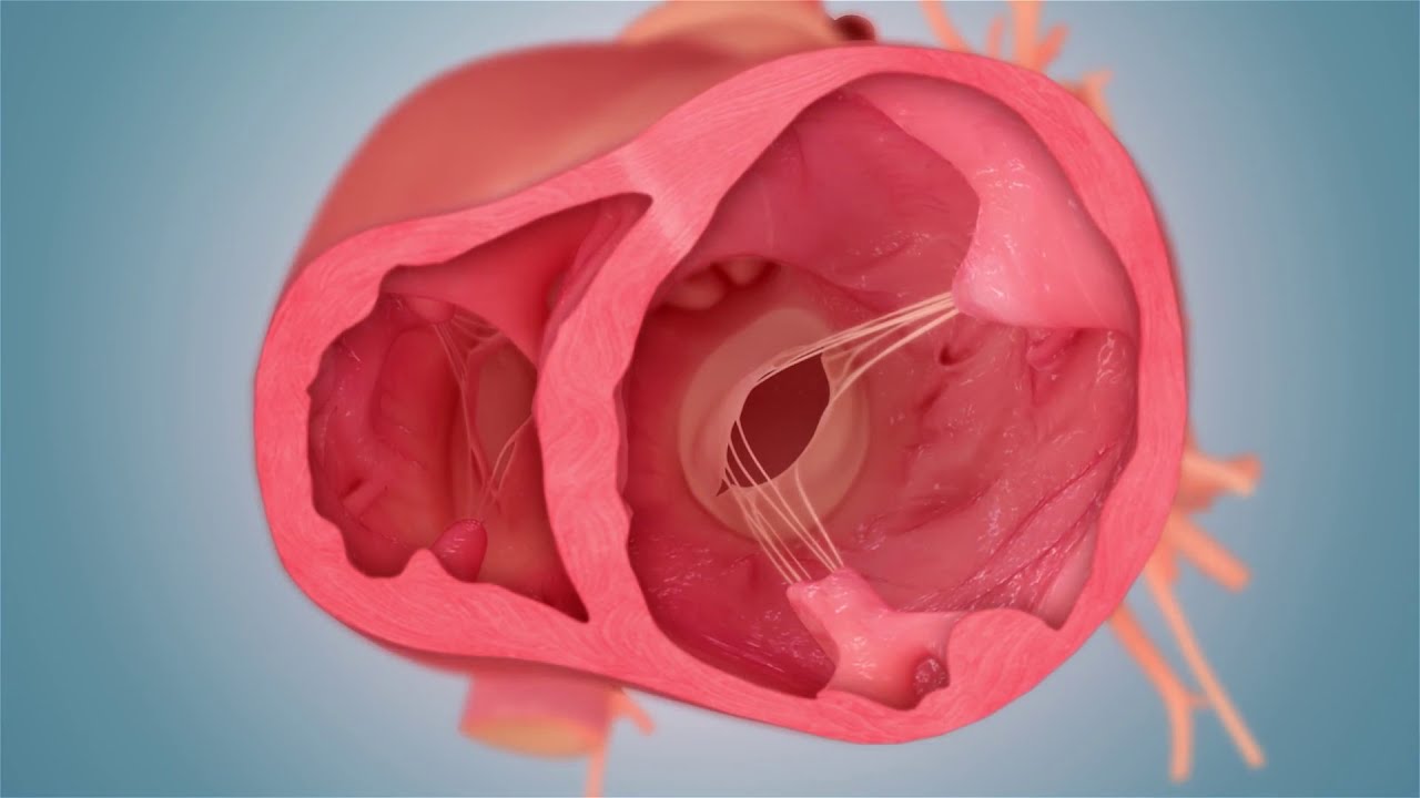 AccuCinch® Ventricular Restoration System - Ancora Heart