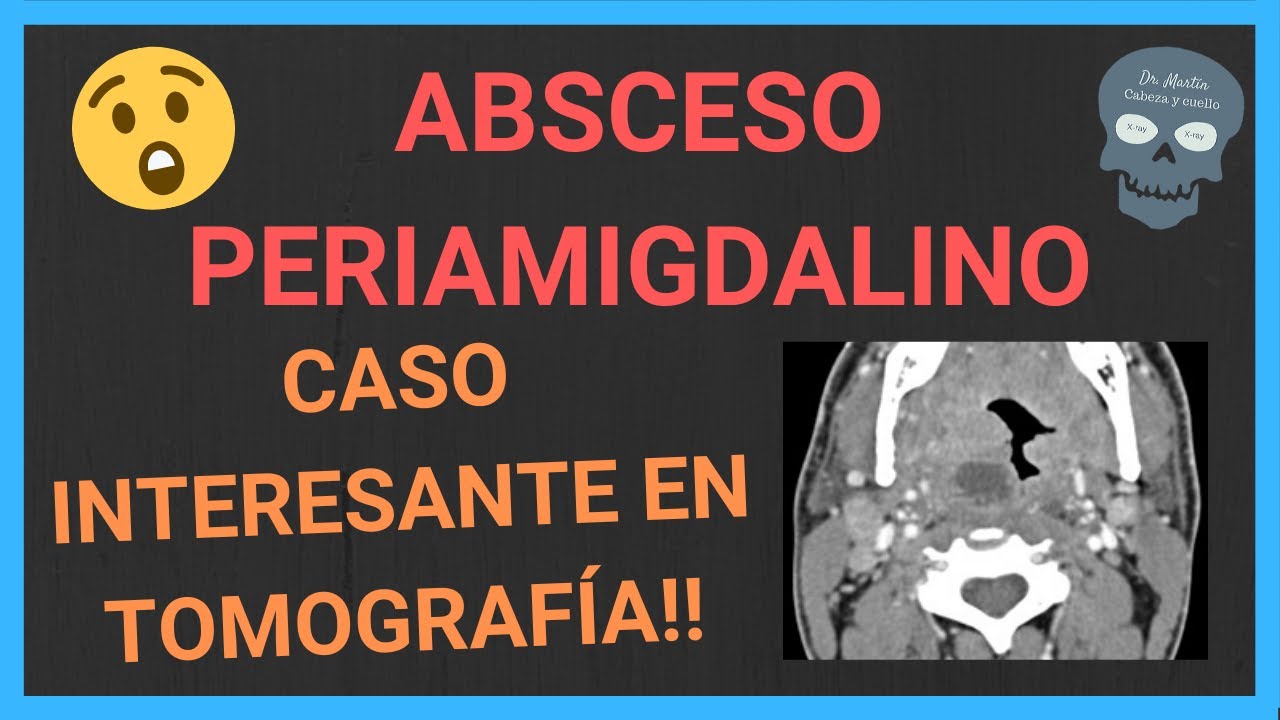 ABSCESO PERIAMIGDALINO [tomografía]💥