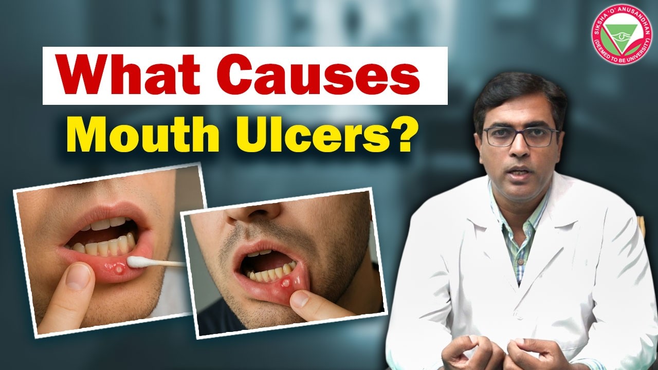 Mouth Ulcers: Types, Causes & Treatment | IDS, SOA University