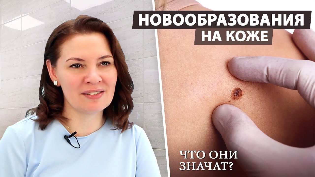 Как распознать и лечить новообразования на коже: советы дерматолога