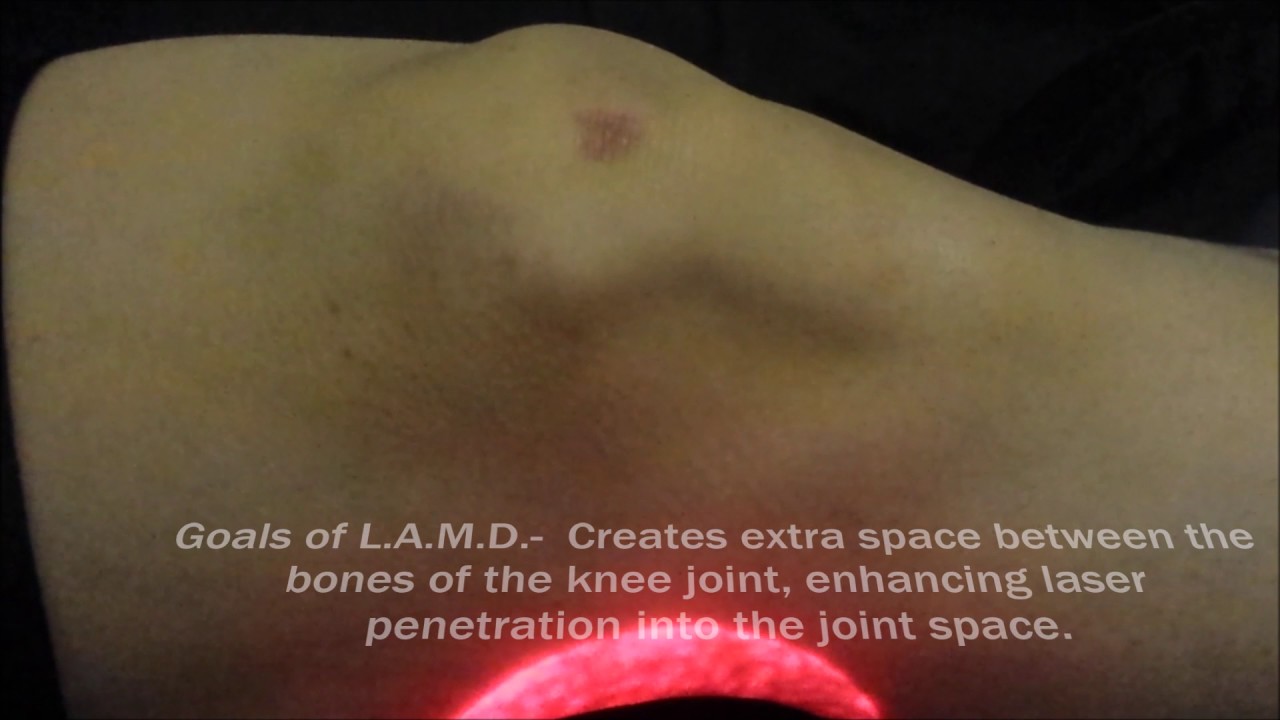 Laser Assisted Meniscal Decompression- The Evolution of Non-Surgical Treatment for Knee Pain