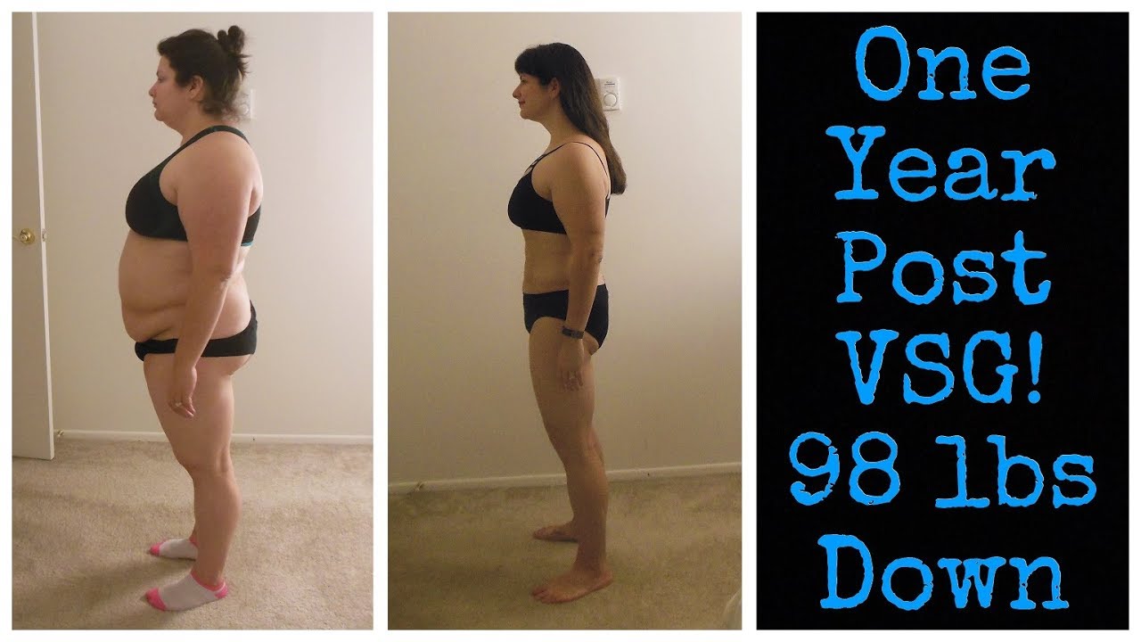 Gastric Sleeve (VSG) - A Year in the Life